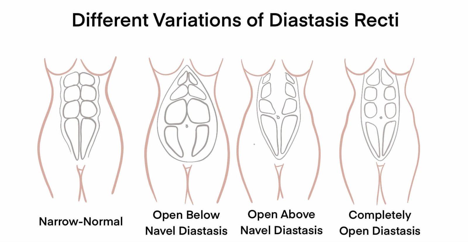 Illustration showing different variations of diastasis recti, including narrow-normal, open below navel, open above navel, and completely open abdominal separation.